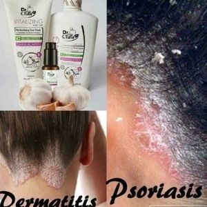 Shampoo for Psorasis